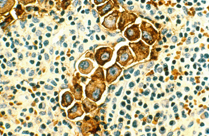 Image: Human metastatic breast cancer in the lymph nodes, stained by immunocytochemical for epithelial membrane antigen (photo courtesy Dr. Lance Liotta Laboratory / National Cancer Institute).